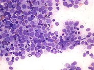 Refractory Anemia with Excess Blasts - 3.