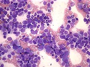 Refractory Anemia with Excess Blasts 4.