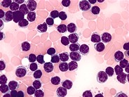 Chronic Lymphocytic Leukemia - 2.