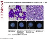 A leukemic presentation of a “triple-hit” lymphoma