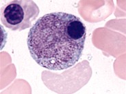 Hypocellular MDS - 8.