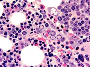 Parvovirus Inclusions - 4.