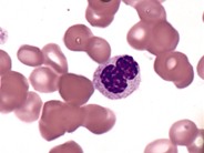 Pseudo Pelger-Huet Cell - 1.