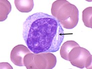 Crystalline Inclusions in Malignant Lymphocytes - 2.