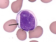 Crystalline Inclusions in Malignant Lymphocytes - 4.