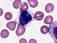 Crystalline Inclusions in Malignant Lymphocytes - 5.