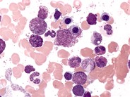 Idiopathic Hypereosinophilic Syndrome - 3.