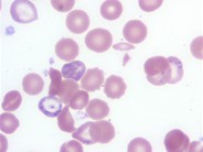 Pappenheimer Bodies - 2.