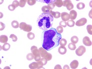 NK Cell Lymphocytosis - 5.