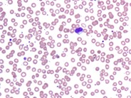 NK Cell Lymphocytosis - 6.