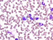NK Cell Lymphocytosis - 7.