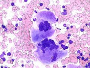 Essential-Thrombocythemia--2