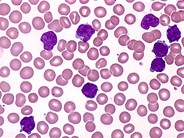 T-cell Prolymphocytic Leukemia - 2.