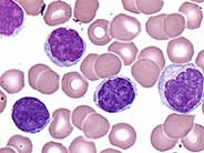 T-cell Prolymphocytic Leukemia - 6.