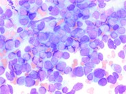 Undifferentiated Metastatic Neuroblastoma - 2.