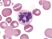 Dysplastic Granulocyte - 1.
