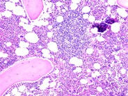 Rituximab-Associated Marrow T-cell Hyperplasia - 1.