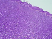 Myeloid Sarcoma -1