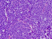 Myeloid Sarcoma-2