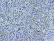 Myeloid Sarcoma -3