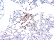 Rituximab-Associated Marrow T-cell Hyperplasia - 4.