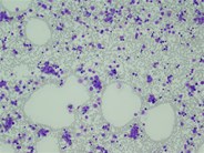 AML with mutated CEBPA