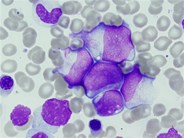 AML with mutated CEBPA