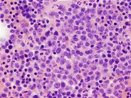 AML with mutated CEBPA