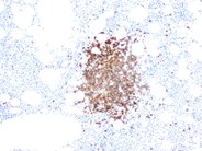 Rituximab-Associated Marrow T-cell Hyperplasia - 7.