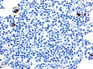 Rituximab-Associated Marrow T-cell Hyperplasia - 8.