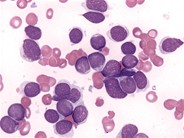 Precursor B-Cell ALL - 3.