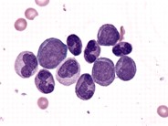 Accelerated Phase of CML - 2.