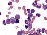 Accelerated Phase of CML - 3.