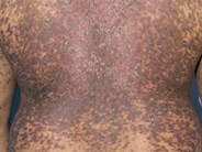 Acute GVHD