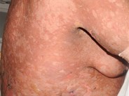 Severe acute GVHD