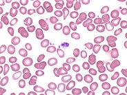 Chronic Idiopathic Myelofibrosis - Peripheral Blood - 3.