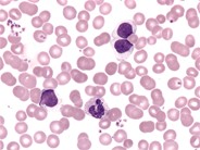 Large Granular Lymphocyte Leukemia - 1.