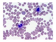 Chronic Neutrophilic Leukemia