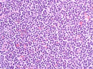 Blastic Mantle Cell Lymphoma - 1.