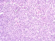 Blastic Mantle Cell Lymphoma - 2.