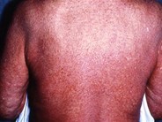 Sézary Syndrome - 1.