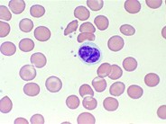 Sézary Syndrome - 2.