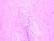 Splenic caseating granulomas - 5.