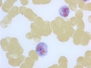 Leukocyte Alkaline Phosphatase Scoring - 3.