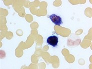 Leukocyte Alkaline Phosphatase Scoring - 5.