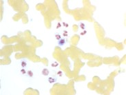 Leukocyte Alkaline Phosphatase Scoring - 8.