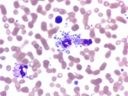 Platelet satellitism due to EDTA Anticoagulant - 3.
