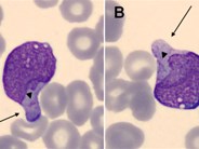 Magic mirror in my hand, which is the lineage in the end? A case of acute leukemia with hand-mirror cells