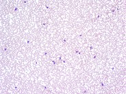 Platelet satellitism due to EDTA  Anticoagulant - 6.