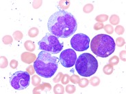 Chemotherapy-Related AML, M4e - 6.